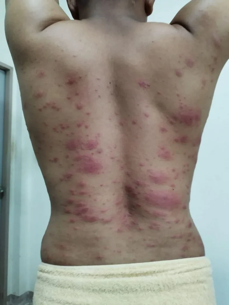 Mystery Rash On Thai Man: Environmental Allergy Suspected After Ineffective Treatment