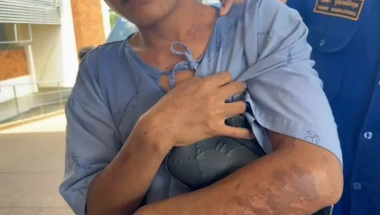 Acid Attack On Thai Teenager Sparks Manhunt In Buriram